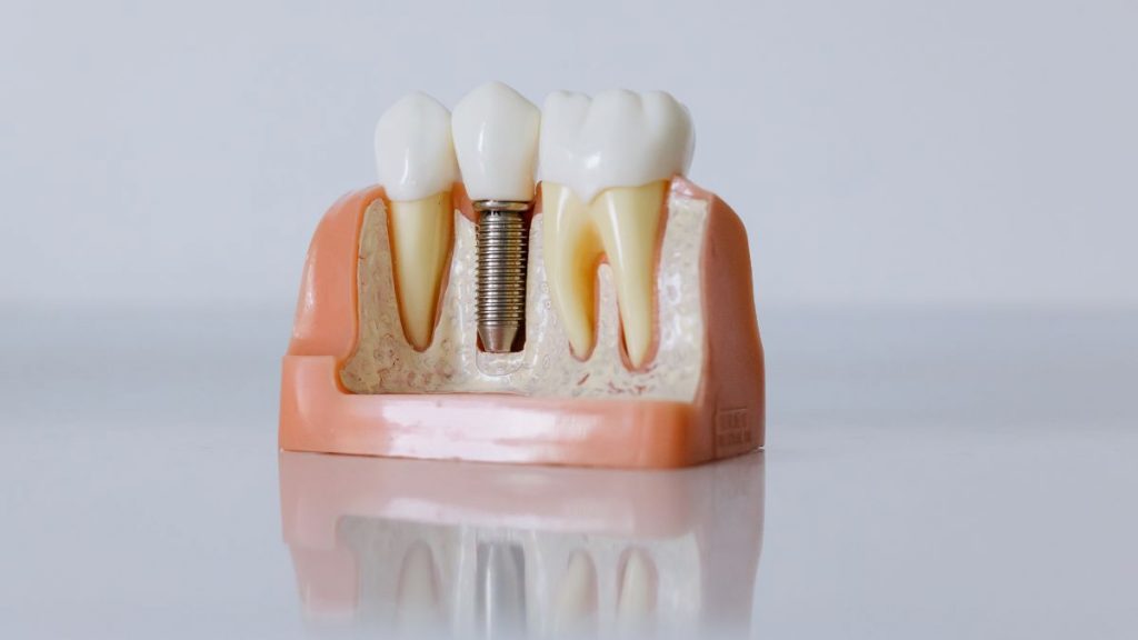 implante dentario pelo sus